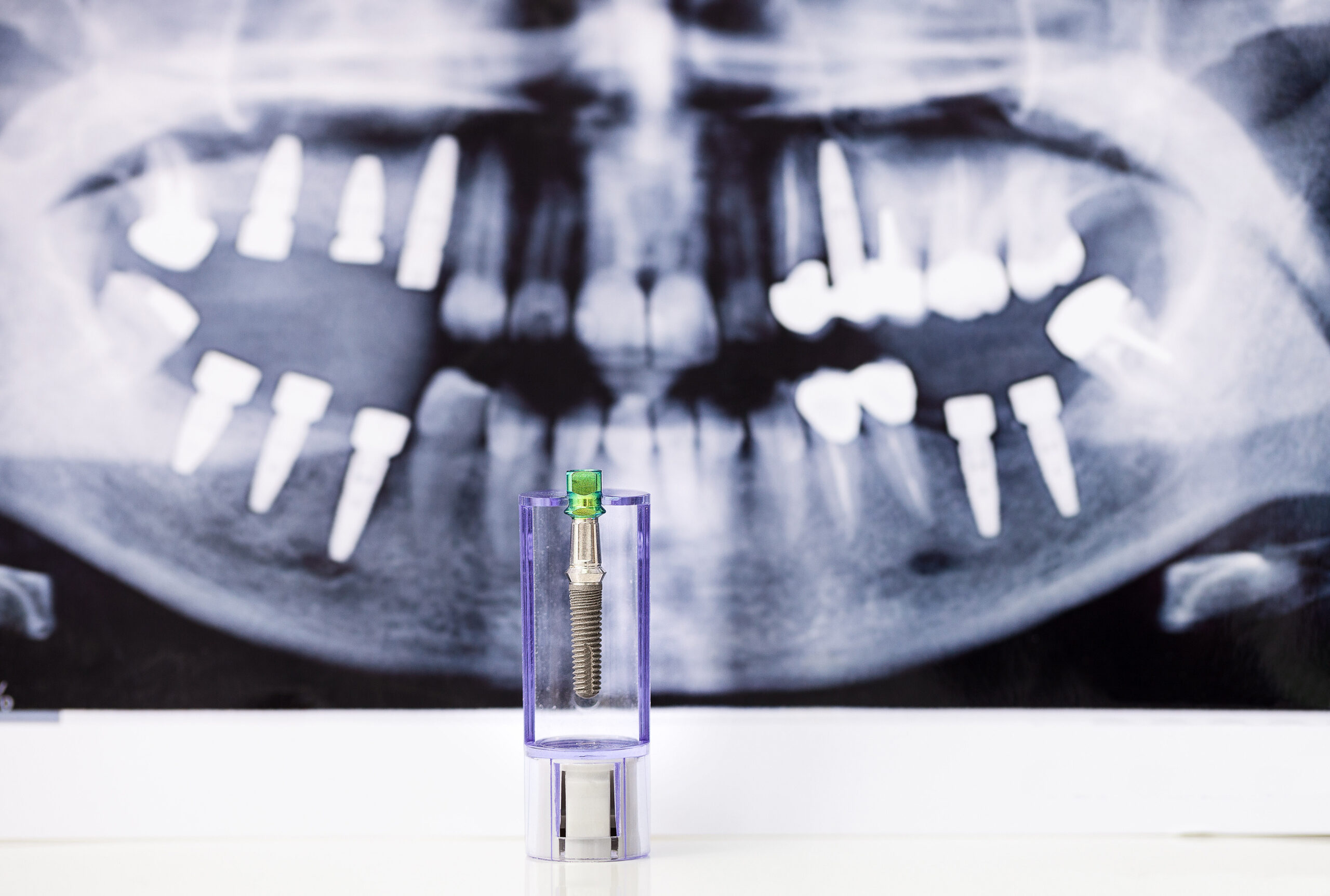 Implantes dentales: la solución innovadora para reemplazar dientes perdidos