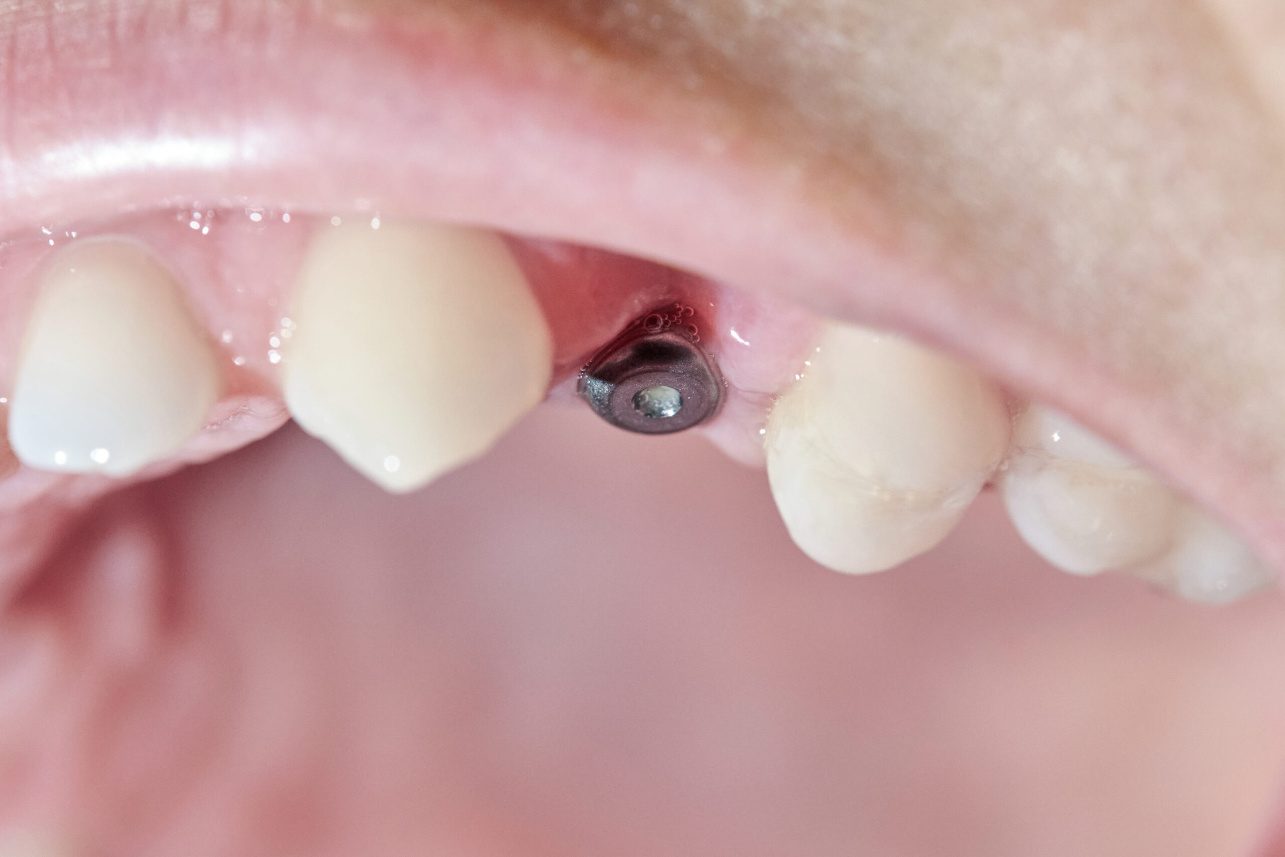 Implantes Dentales La Solución Para Reemplazar Dientes Perdidos 1315